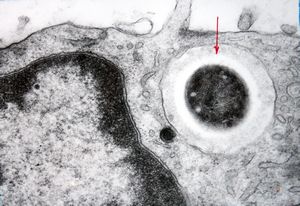 M,43y. | blood - degraded Candida (bone marrow suppression) M,43y. | blood - degraded Candida (bone marrow suppression)